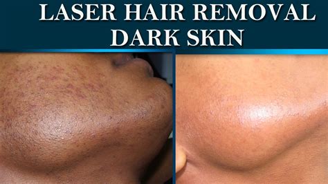 laser tanning removal|laser hair removal tanned skin.